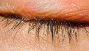Demodex grinje na licu — simptomi, uzroci i nega kože