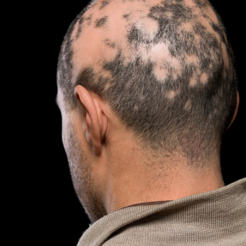Alopecija kose