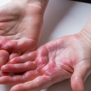Ekcem i atopijski dermatitis — zašto koža svrbi i kako je negovati