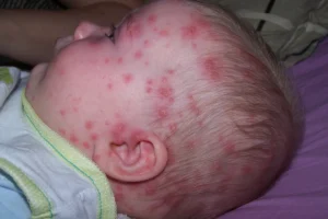 Ovčije boginje kod dece – simptomi, koliko traju, kada dete sme napolje i u vrtić