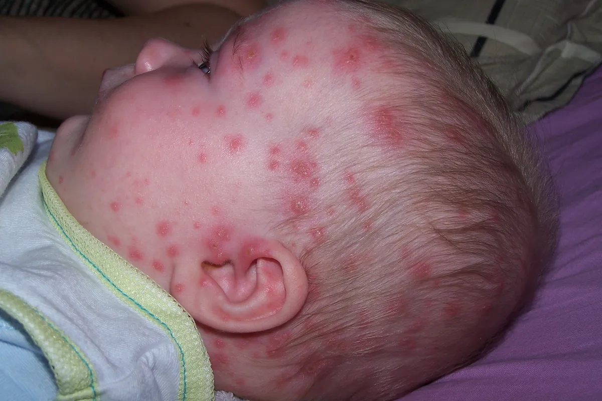 Ovčije boginje kod deteta — crvene tačkice i plikovi na koži glave